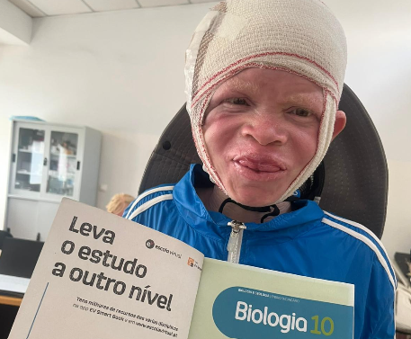 historias de esperanza de africa directo niño albino proyecto solidario de mozalbinismo