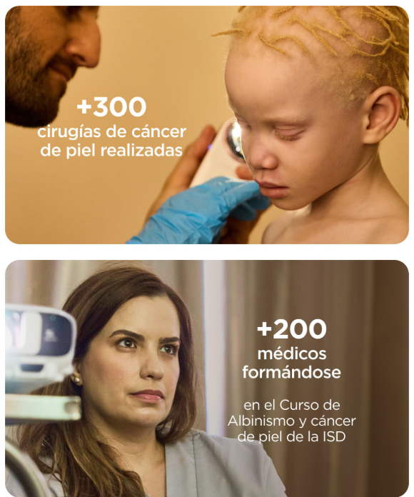Parte superior: profesional de la salud con guantes azules realiza procedimiento en la cabeza de un paciente con cabello rubio rizado. Texto: “+300 cirugías de cáncer de piel realizadas”. Parte inferior: persona frente a equipo médico durante una formación. Texto: “+200 médicos formándose en el Curso de Albinismo y cáncer de piel de la ISD”.