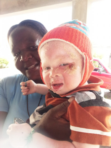 niño albino en la lucha contra el cáncer de piel con una señora africana